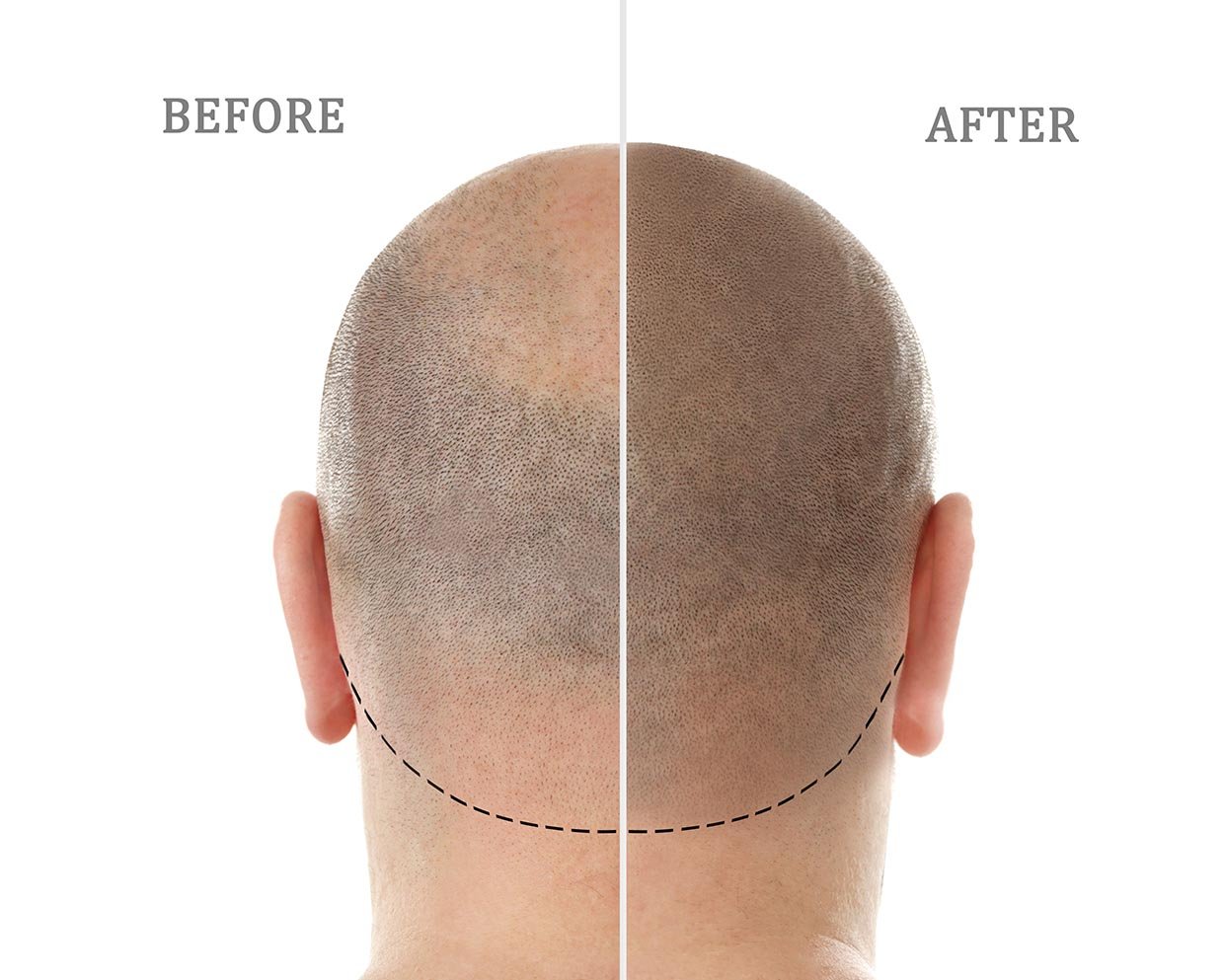 Scalp Micropigmentation by Alex Milligan