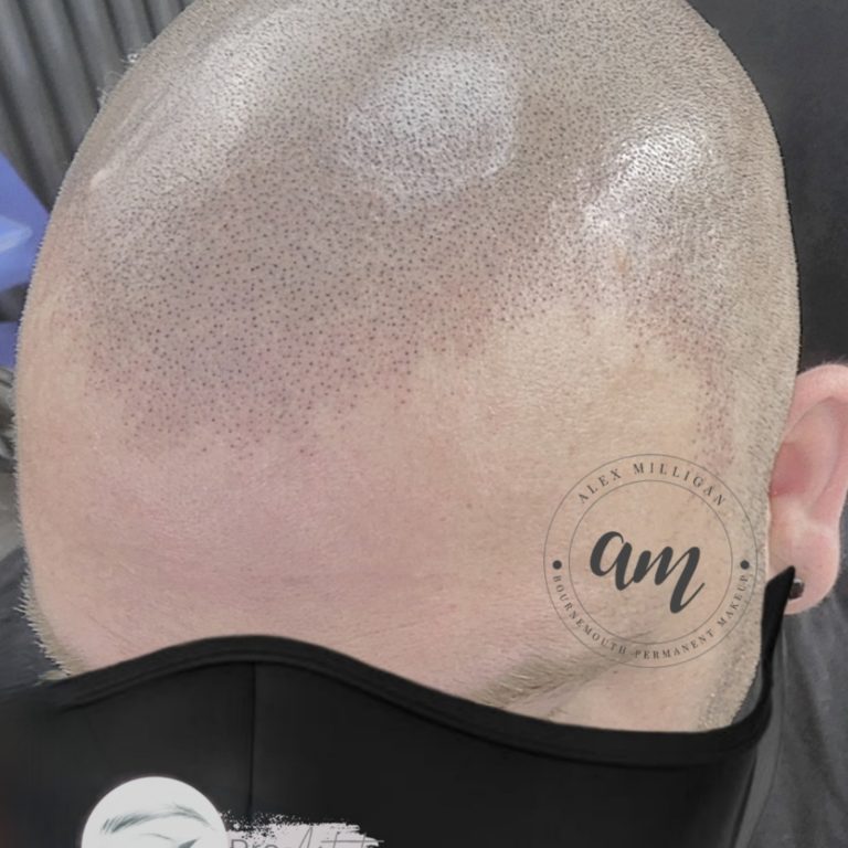 SMP Hairline tattoo Alex Milligan