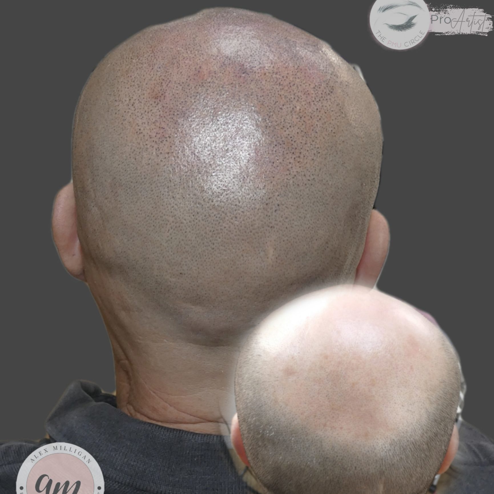 AFTER SCALP MICROPIGMENTATION BY ALEX MILLIGAN - back of head