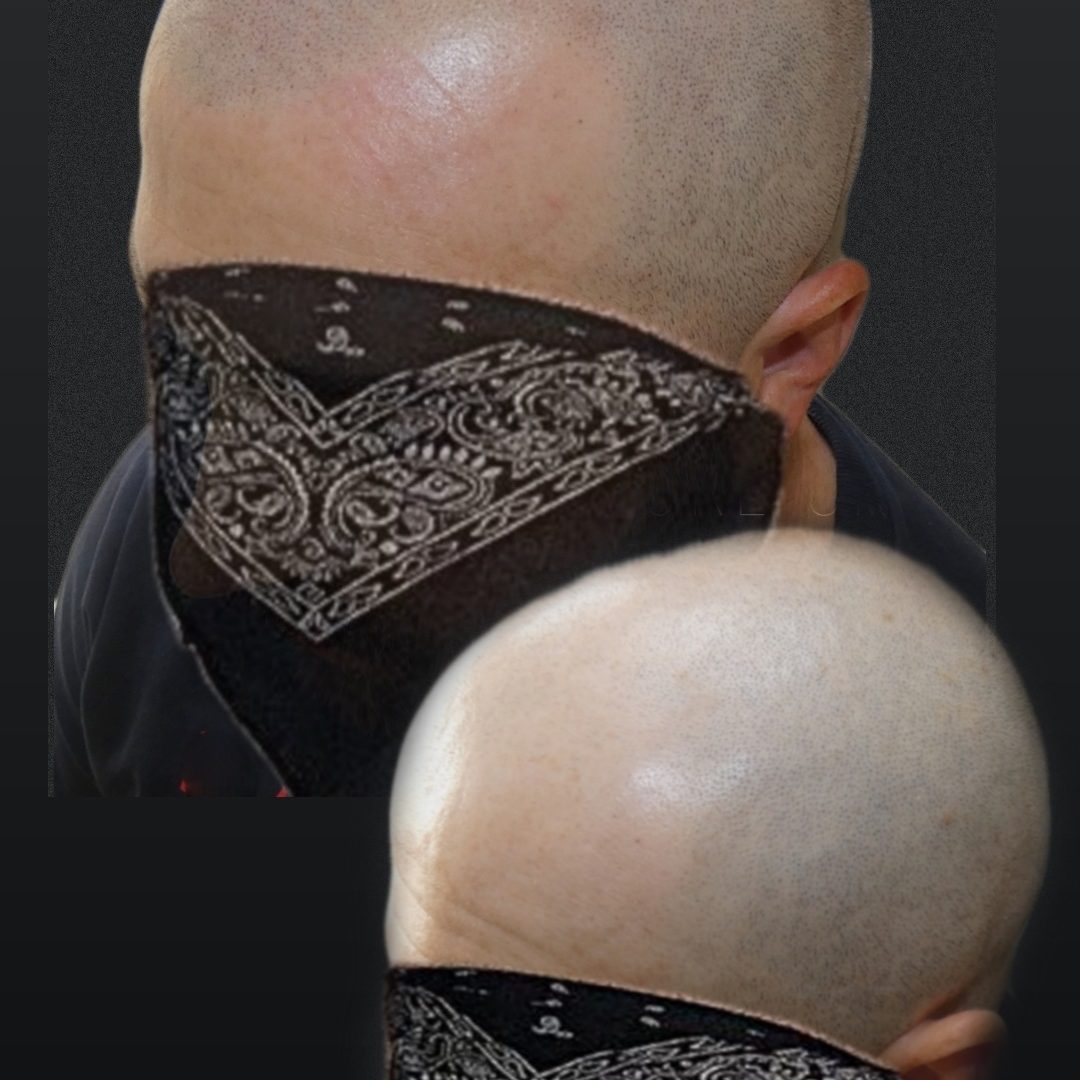 SCALP MICROPIGMENTATION - before and after - baldness solution by Alex Milligan