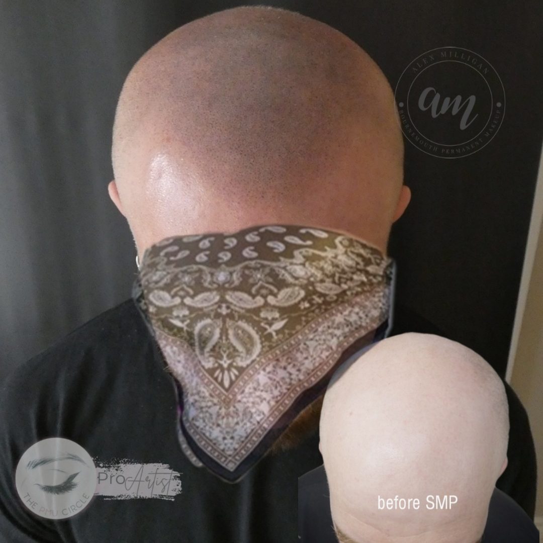 SMP: scalp micropigmentation - by alex milligan