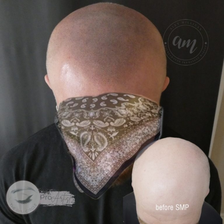 SMP: scalp micropigmentation - by alex milligan