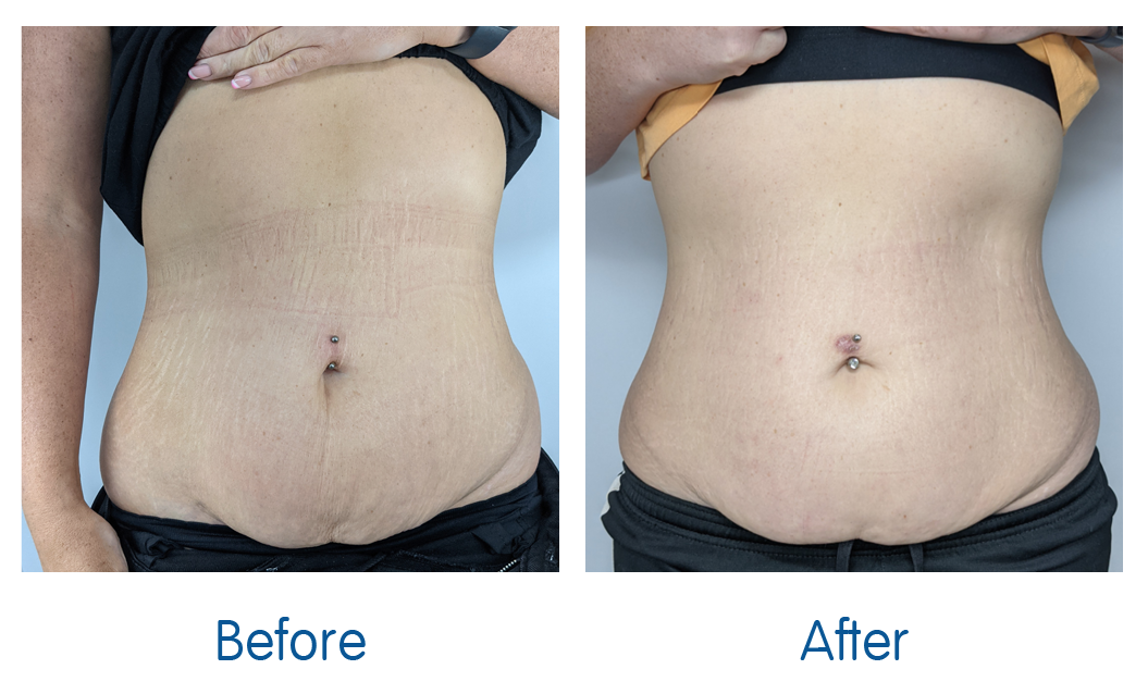 Focus Dual Before and After Stretchmark on Stomach after weight loss