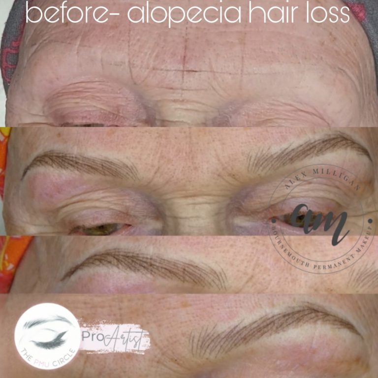 Before and after combination brows - alopecia - Alex Milligan